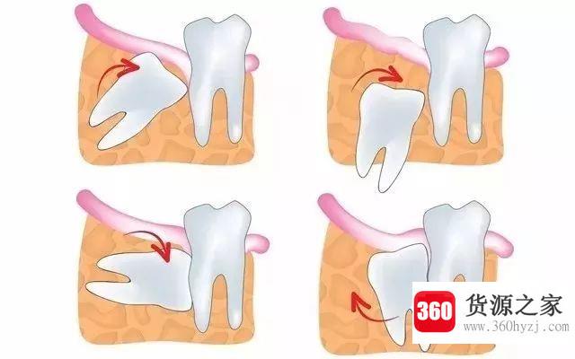 智齿一定要拔吗？